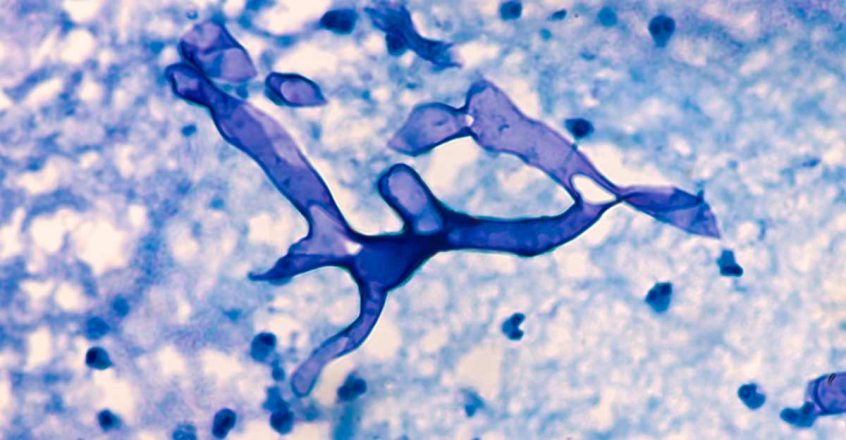 Govt urges states, UTs to make black fungus notifiable ...